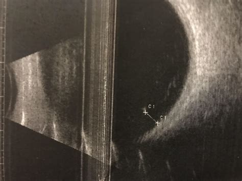 Floater ultrasound picture. It's my most bothersome one. Distance