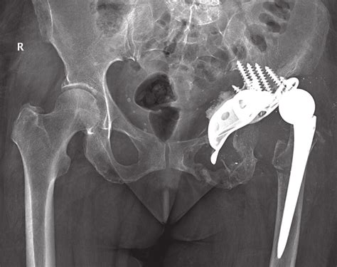 Diagram X Ray Pelvis Diagram Mydiagram Online