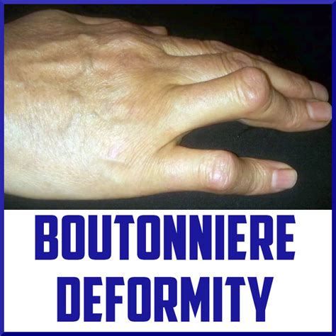 Overview of the Traumatic Boutonniere Deformity - foppa.casa