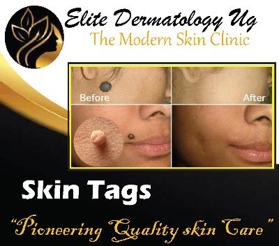 Comprehensive Guide to Skin Tags: Causes, Treatment, and Prevention ...