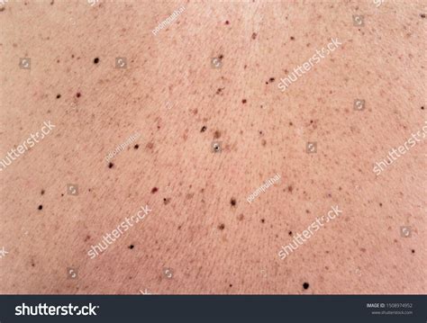 Skin Texture Black Birthmarks Moles On Stock Photo 1508974952