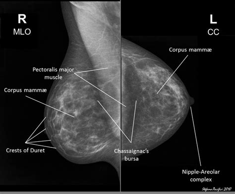 How Mammography Works A Complete Guide For Women