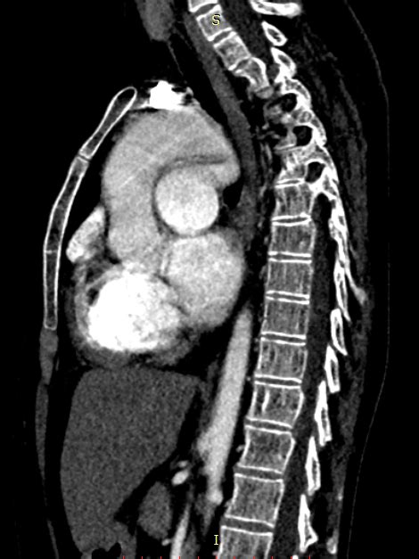 Persistierender Ductus Arteriosus Pacs