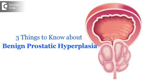 3 Important Things To Know About Benign Prostatic Hyperplasiabph Dr