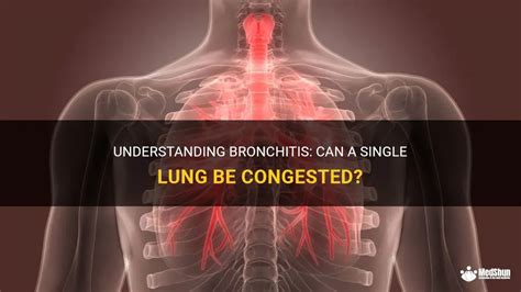 Understanding Bronchitis: Can A Single Lung Be Congested? | MedShun