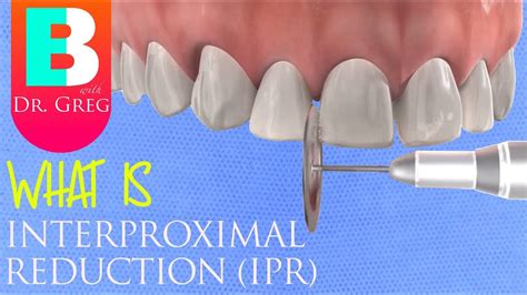 Interproximal Reduction IPR Stripping Of Teeth For Braces Or