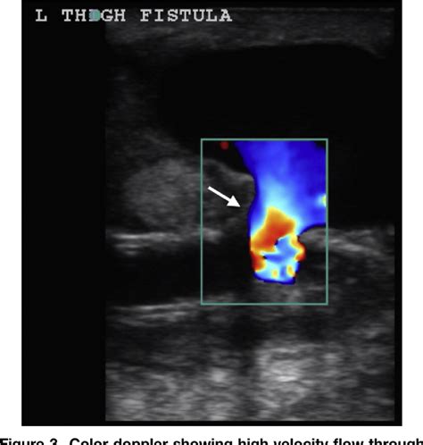 Figure From Diagnosis Of An Arteriovenous Av Graft Pseudoaneurysm