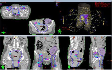 Plan For Case 3 Definitive Radiation Therapy To Primary Pelvic And Download Scientific