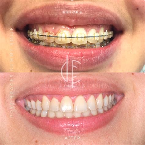 Swollen Gums Overgrown Gingiva During Orthodontic Treatment Causes