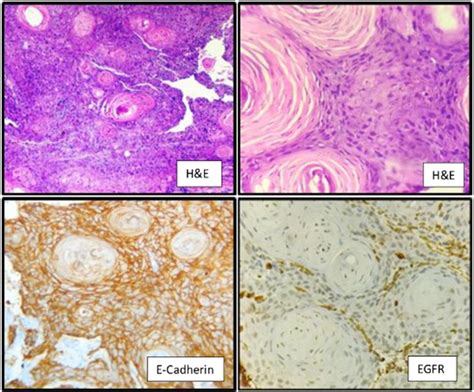 Well Differentiated Squamous Cell Carcinoma Showing Bright Expression