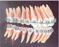 Basics Of Orthodontic Appliances Flashcards Quizlet