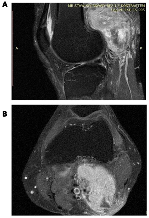 Cancers Free Full Text Diagnostics And Treatment Of Extrameningeal