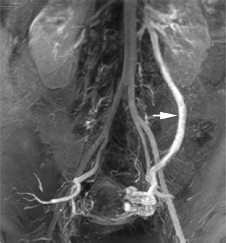 Pelvic And Gonadal Venous Reflux Radiology Key