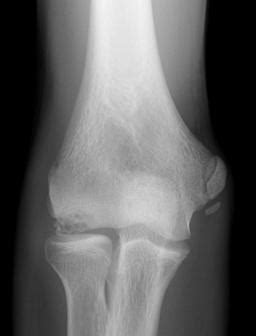 Osteochondritis Dissecans of Elbow - Shoulder & Elbow - Orthobullets