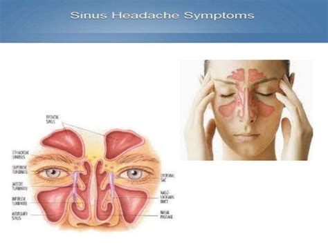 Sinus headache | PPT