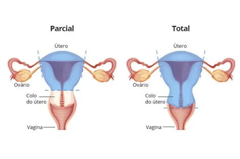 Histerectomia O Que Indica Es Tipos E Cuidados P S Operat Rio