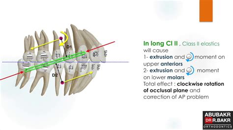 Long And Short Class Ii Elastics Youtube