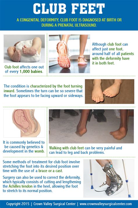 Fantastic Info About How To Fix Club Foot Waterask