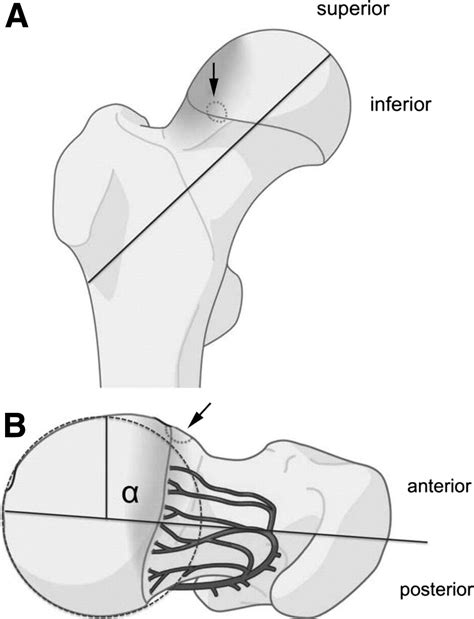 Arthroscopic Appearance And Treatment Of Impingement Cysts At Femoral