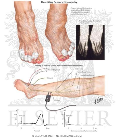 Hereditary Sensory Neuropathy