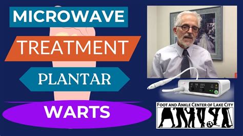 Swift Microwave Treatment For Plantar Warts Foot And Ankle Center Of