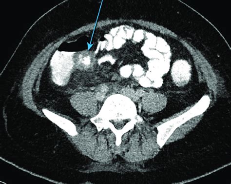 Tomodensitom Trie De L Abdomen Coupe Axiale Fl Che Il Ite Terminale