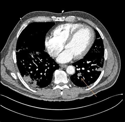 Computed Tomography Pulmonary Angiogram Demonstrating Pulmonary Download Scientific Diagram