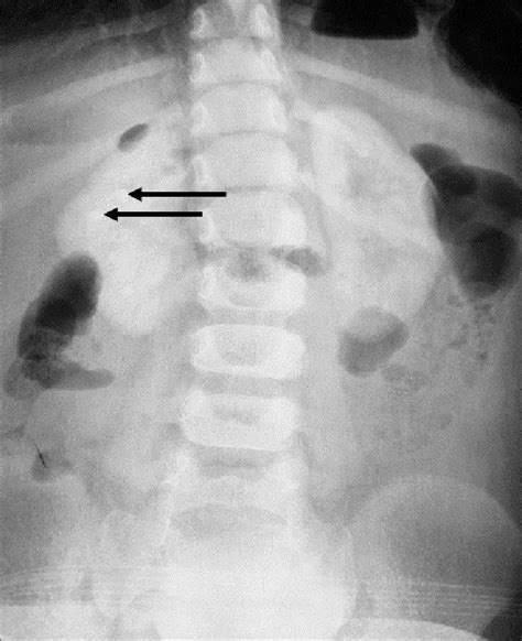 Abdominal X Ray With Primary Hyperoxaluria Showing Nephrocalcinosis As