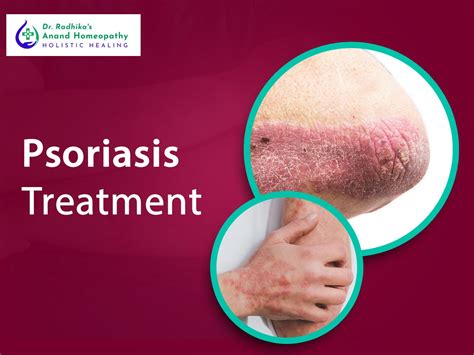 Learn Everything There Is To Know About Psoriasis And Its Treatment By Dr Radhika S Anand