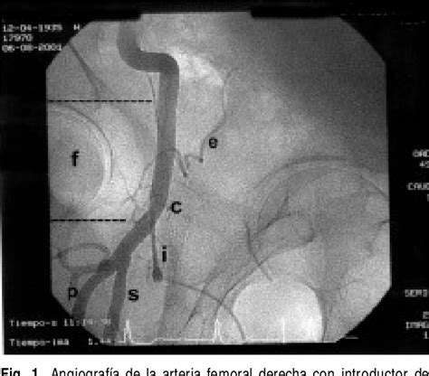 Figure 1 From Complicaciones Del Acceso Femoral En El Cateterismo