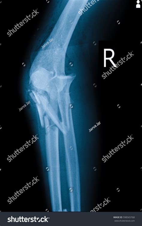 Xray Image Show Closed Fracture Right Stock Photo 598565768 | Shutterstock