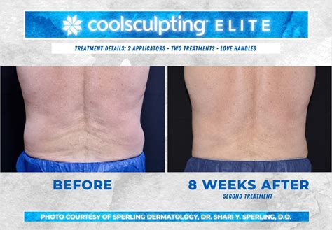 Love Handles Coolsculpting Before And After Patient 06 Sperling Dermatology