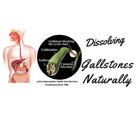 Dissolving Gallstones Naturally