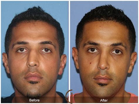 Ethnic Rhinoplasty Before After Photos From Dr Kevin Sadati