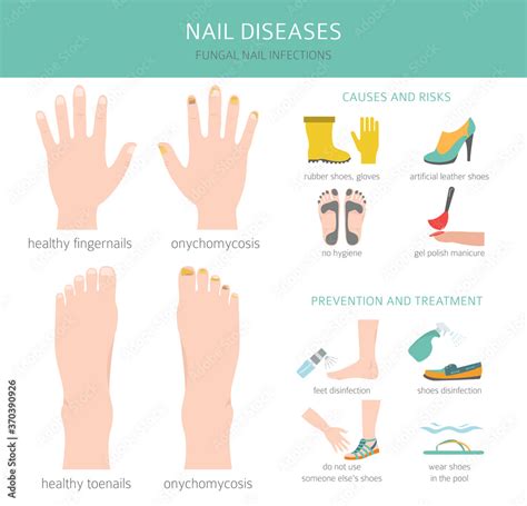 Nail diseases. Onychomycosis, nail fungal infection causes, treatment icon set. Medical ...