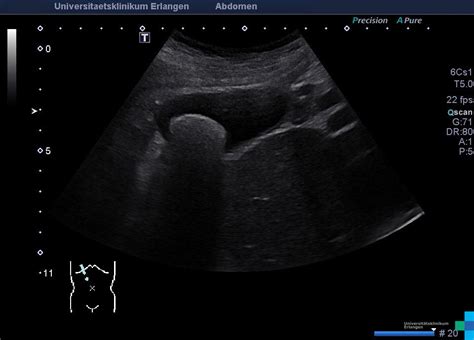 Gallbladder Stones Atlas Of Ultrasound