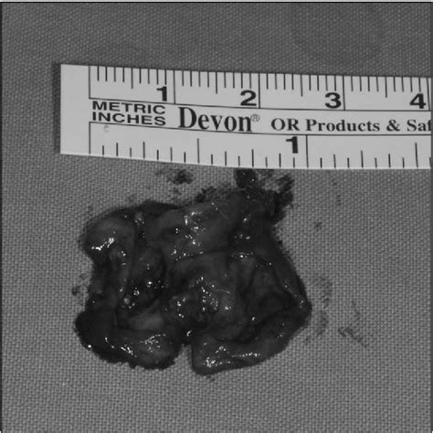 Figure 3 From Primary Intraosseous Squamous Cell Carcinoma Arising From Odontogenic Cyst A Case