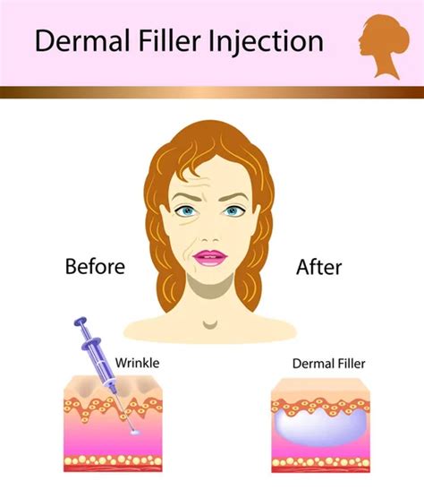 Facial Dermal Fillers Vector Art Stock Images Depositphotos