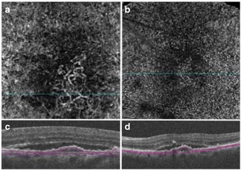 Spectral Domain Sd Optical Coherence Tomography Angiography Of A Type