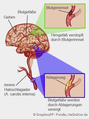 Schlaganfall Ursachen Netdoktor At