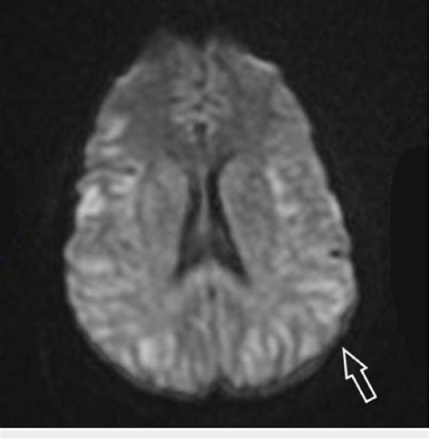 Magnetic Resonance Imaging Of The Brain Showing Symmetrically