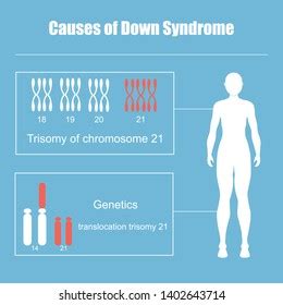 Causes Down Syndrometrisomy Chromosome 21 Stock Illustration 1402643714 ...