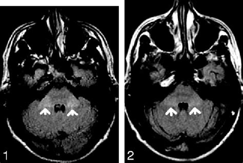 Figure 1 From Hyperintensity Of The Middle Cerebellar Peduncles On Fluid Attenuated Inversion