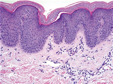 Confluent Scaly Erythematous Plaques On The Trunk Of A 16 Year Old Boy—quiz Case Dermatology