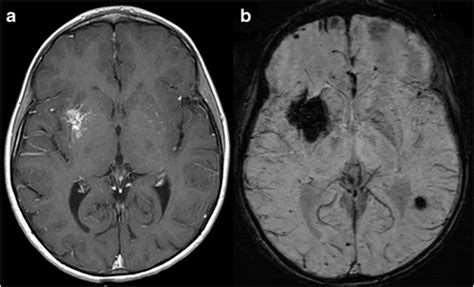 A Axial Contrast Enhanced T1 Weighted Mr Image And B Axial Mip Swi