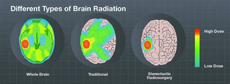 What is Radiation Therapy? - Brainlab.org