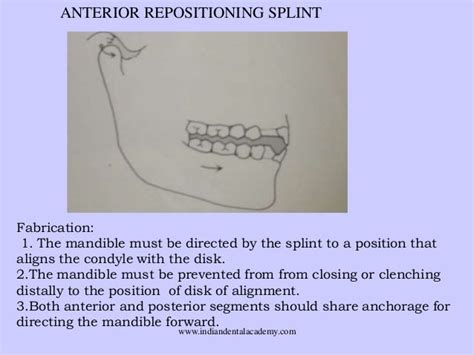 Orthodontic Splints Certified Fixed Orthodontic Courses By Indian De