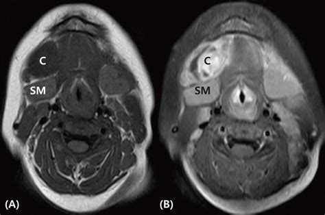 Axial Magnetic Resonance Images Through The Submandibular Region