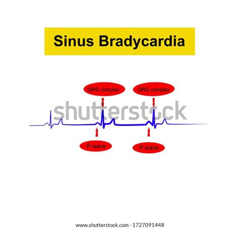 Sinus Bradycardia Ecg Heart Rate Slower Stock Vector Royalty Free