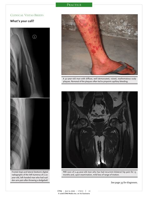 (PDF) Psoriasis with Auspitz sign